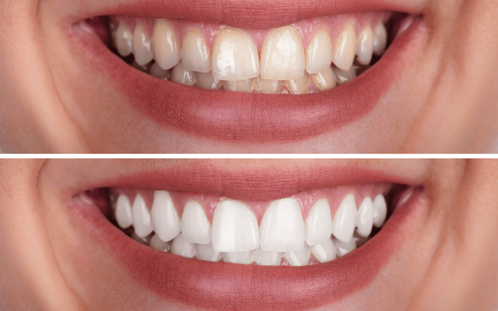 Teeth-whitening